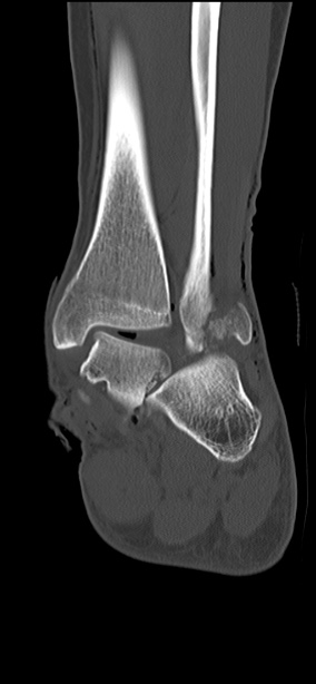 Chopart fracture (Radiopaedia 35347-36851 Coronal bone window 28).jpg