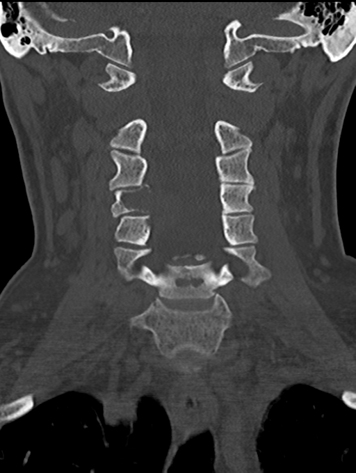 Chordoma (C4 vertebra) (Radiopaedia 47561-52188 Coronal bone window 24).png