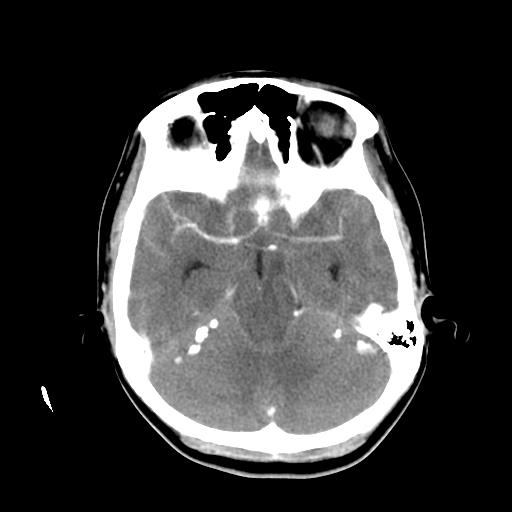 File:Choriocarcinoma of ovary with cerebral and pulmonary metastases (Radiopaedia 25983-26118 A 8).jpg