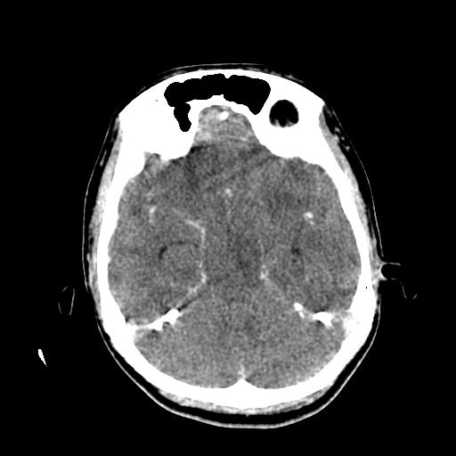 File:Choriocarcinoma of ovary with cerebral and pulmonary metastases (Radiopaedia 25983-26118 C+ arterial phase 59).jpg