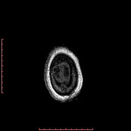 File:Choroid plexus xanthogranuloma (Radiopaedia 67843-77270 Axial T1 18).jpg