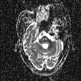 Choroid plexus xanthogranuloma - unilateral (Radiopaedia 85632-101393 Axial ADC 17).jpg