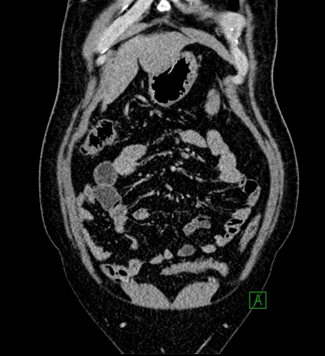 Chromophobe renal cell carcinoma (Radiopaedia 84286-99573 H 38).jpg