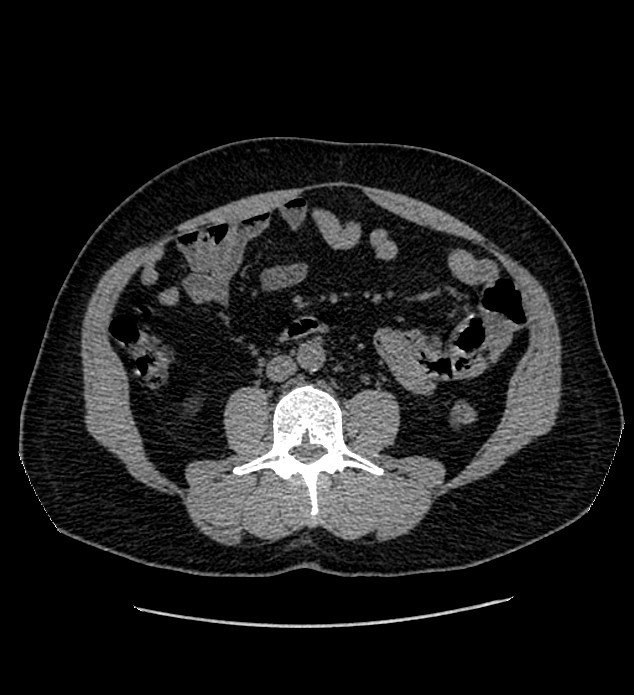 Chromophobe renal cell carcinoma (Radiopaedia 84337-99693 Axial non-contrast 78).jpg
