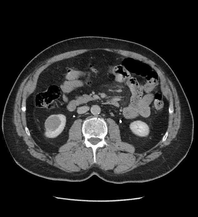 Chromophobe renal cell carcinoma (Radiopaedia 86879-103083 D 67).jpg