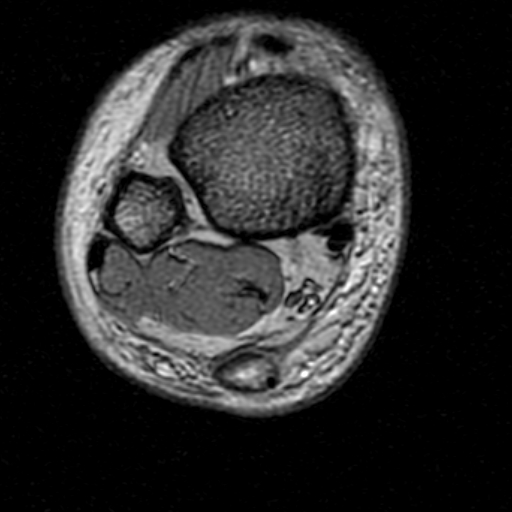 File:Chronic Achilles tendon rupture (Radiopaedia 15262-15100 Axial Gradient Echo 5).jpg