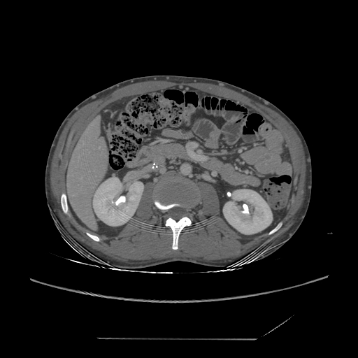File:Chronic IVC thrombosis and resultant IVC filter malposition (Radiopaedia 81158-94800 A 87).jpg