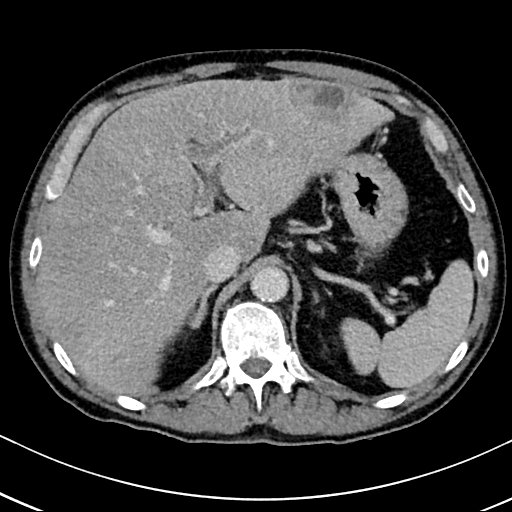 Chronic appendicitis complicated by appendicular abscess, pylephlebitis and liver abscess (Radiopaedia 54483-60700 B 43).jpg