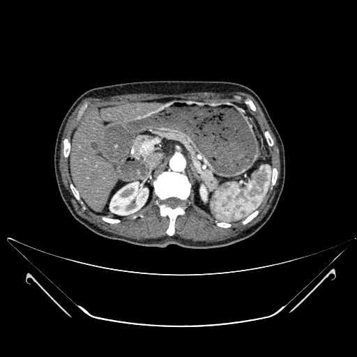 File:Chronic contained rupture of abdominal aortic aneurysm with extensive erosion of the vertebral bodies (Radiopaedia 55450-61901 A 10).jpg