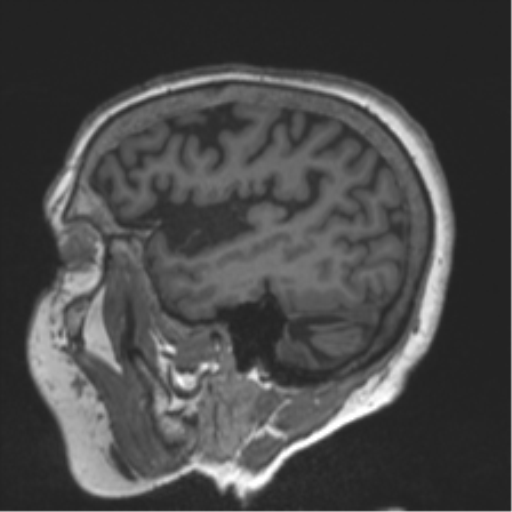 Chronic hypertensive encephalopathy (Radiopaedia 39993-42482 Sagittal T1 24).png