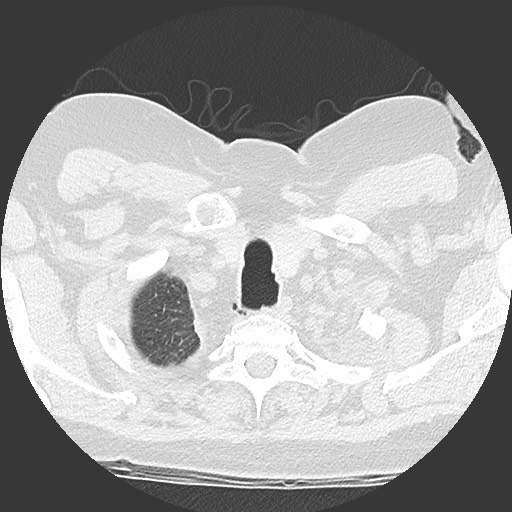File:Chronic lung allograft dysfunction - restrictive form (Radiopaedia 60595-68316 Axial lung window 5).jpg