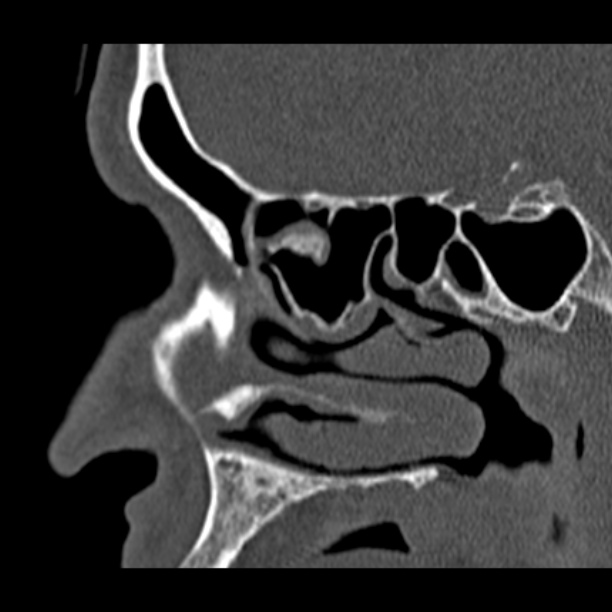 Chronic maxillary sinusitis (Radiopaedia 27879-28116 Sagittal bone window 20).jpg