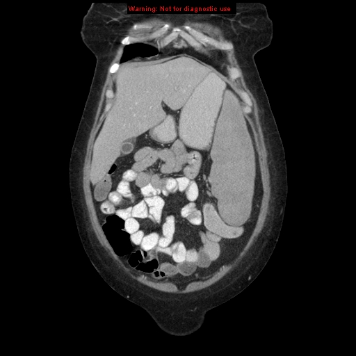 File:Chronic myeloid leukemia with splenic infarction (Radiopaedia 9178-9874 E 1).jpg