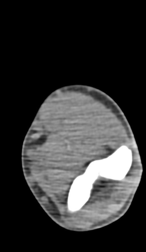 Chronic osteomyelitis of the distal humerus (Radiopaedia 78351-90971 Axial non-contrast 86).jpg