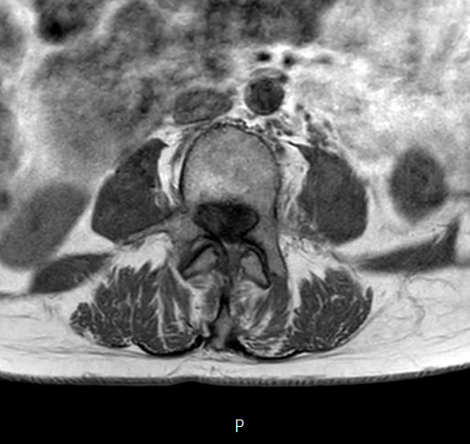File:Chronic spinal hematoma with cauda equina syndrome (Radiopaedia 75745-87090 Axial T1 16).png