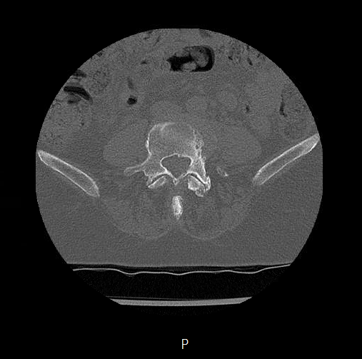 File:Chronic spinal hematoma with cauda equina syndrome (Radiopaedia 75745-88197 Axial bone window 49).png
