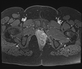 File:Class II Mullerian duct anomaly- unicornuate uterus with rudimentary horn and non-communicating cavity (Radiopaedia 39441-41755 Axial T1 fat sat 129).jpg