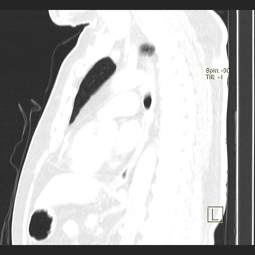 Classic complicated silicosis (Radiopaedia 49720-54961 Sagittal lung window 29).jpg