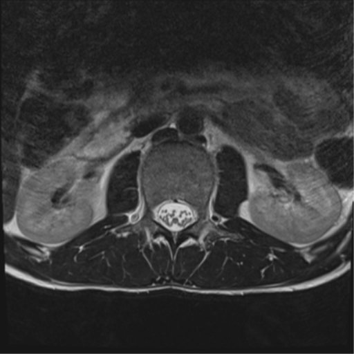 File:Clear cell meningoma - lumbar spine (Radiopaedia 60116-67690 Axial T2 36).png