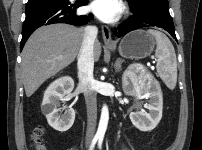 File:Clear cell renal cell carcinoma (Radiopaedia 61449-69393 C 17).jpg