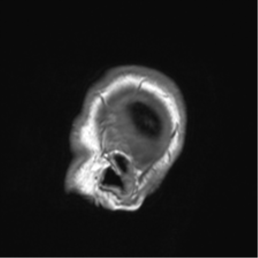 Clival chordoma invading the hypoglossal canal (Radiopaedia 48850-53887 Sagittal T1 88).png