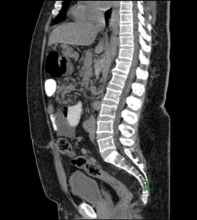 Closed-loop small bowel obstruction-internal hernia (Radiopaedia 78439-91096 C 77).jpg