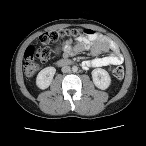File:Closed-loop small bowel obstruction (Radiopaedia 73713-84509 A 79).jpg