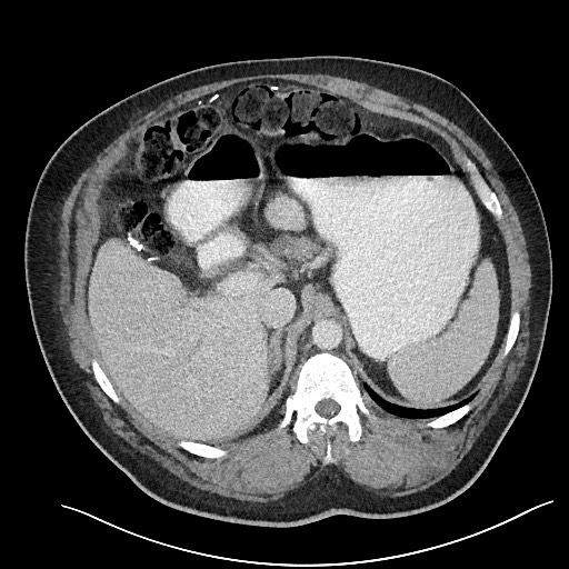 File:Closed loop obstruction - internal hernia into nephrectomy bed (Radiopaedia 59867-67320 A 37).jpg