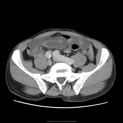 Closed loop small bowel obstruction (Radiopaedia 59227-66554 A 61).jpg