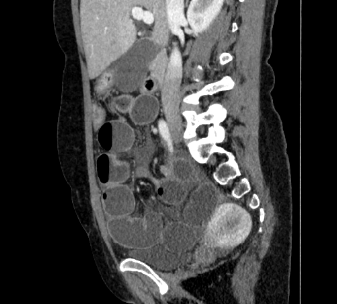 Closed loop small bowel obstruction (Radiopaedia 71211-81508 C 56).jpg