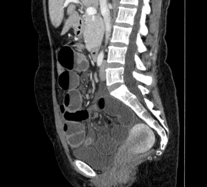 Closed loop small bowel obstruction (Radiopaedia 71211-81508 C 69).jpg
