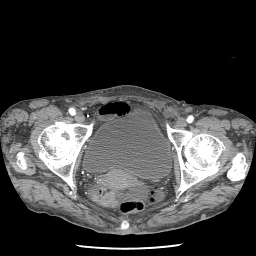 Closed loop small bowel obstruction - adhesions and infarct (Radiopaedia 85125-100678 A 191).jpg