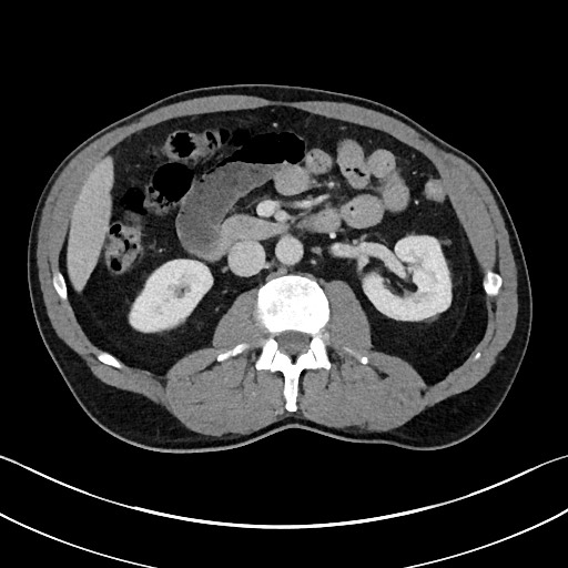 Closed loop small bowel obstruction - internal hernia (Radiopaedia 57806-64778 B 53).jpg