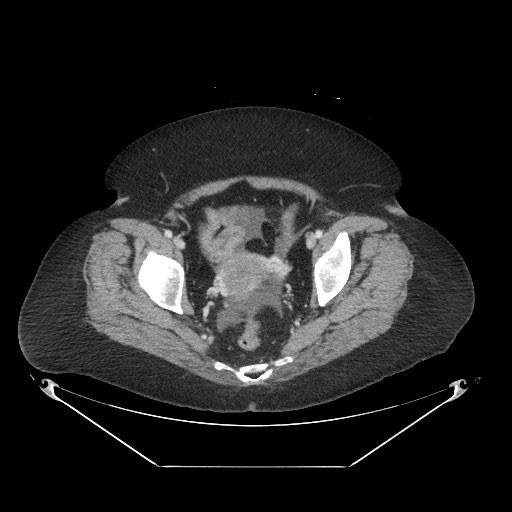 Closed loop small bowel obstruction - internal hernia (Radiopaedia 65402-74450 A 117).jpg
