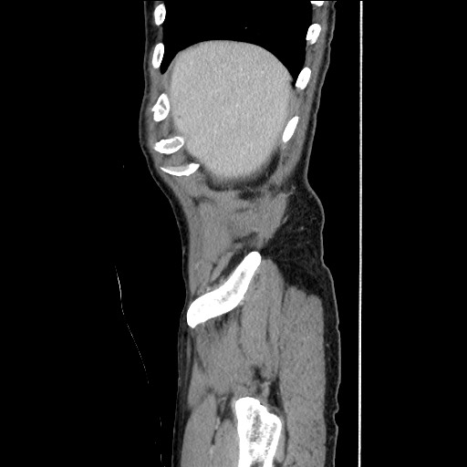 Closed loop small bowel obstruction - omental adhesion causing "internal hernia" (Radiopaedia 85129-100682 C 34).jpg