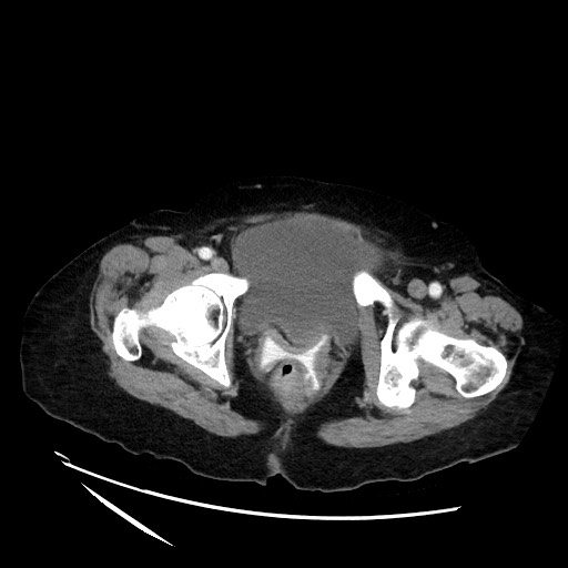 File:Closed loop small bowel obstruction due to adhesive band, with intramural hemorrhage and ischemia (Radiopaedia 83831-99017 Axial 126).jpg
