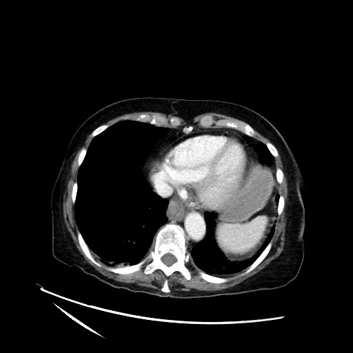 File:Closed loop small bowel obstruction due to adhesive band, with intramural hemorrhage and ischemia (Radiopaedia 83831-99017 Axial 131).jpg