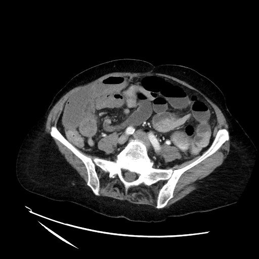 File:Closed loop small bowel obstruction due to adhesive band, with intramural hemorrhage and ischemia (Radiopaedia 83831-99017 Axial 30).jpg