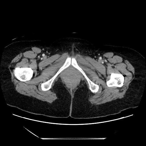 File:Closed loop small bowel obstruction due to adhesive bands - early and late images (Radiopaedia 83830-99014 A 168).jpg