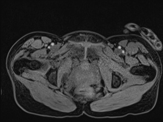 File:Closed loop small bowel obstruction in pregnancy (MRI) (Radiopaedia 87637-104031 G 27).jpg