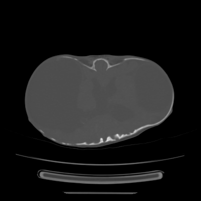 Cloverleaf skull (Radiopaedia 91901-109710 Axial bone window 91).jpg