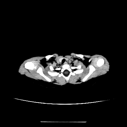 Cloverleaf skull (Radiopaedia 91901-109710 Axial non-contrast 3).jpg
