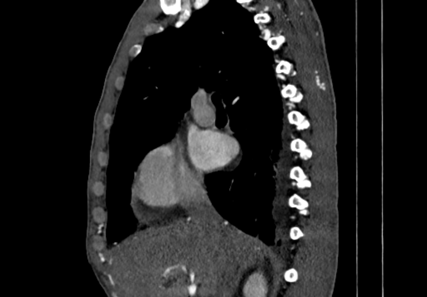 Coarctation of aorta with aortic valve stenosis (Radiopaedia 70463-80574 B 8).jpg