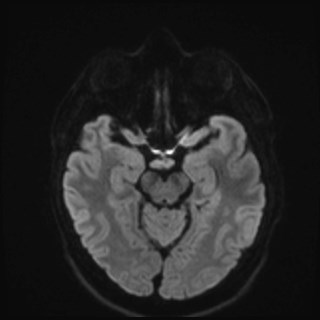 File:Cochlear incomplete partition type III associated with hypothalamic hamartoma (Radiopaedia 88756-105498 Axial DWI 56).jpg