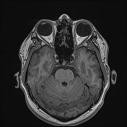 File:Cochlear incomplete partition type III associated with hypothalamic hamartoma (Radiopaedia 88756-105498 Axial T1 73).jpg
