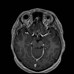 Cochlear incomplete partition type III associated with hypothalamic hamartoma (Radiopaedia 88756-105498 Axial T1 C+ 85).jpg
