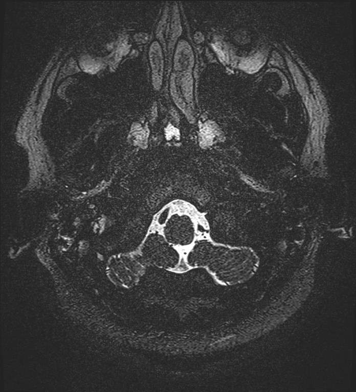 Cochlear incomplete partition type III associated with hypothalamic hamartoma (Radiopaedia 88756-105498 Axial T2 14).jpg