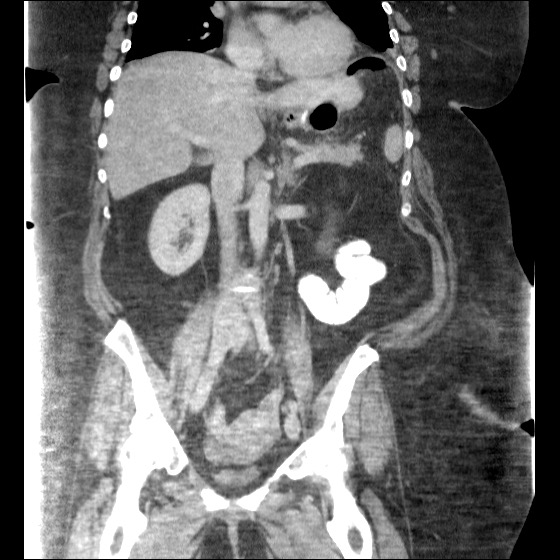 File:Collection due to leak after sleeve gastrectomy (Radiopaedia 55504-61972 B 27).jpg