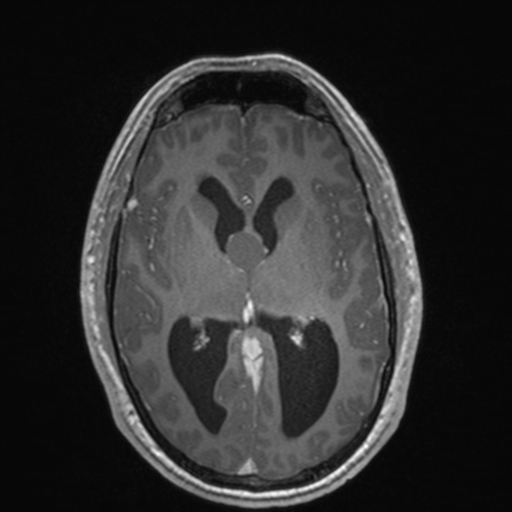 File:Colloid cyst (Radiopaedia 44510-48181 Axial T1 C+ 94).png