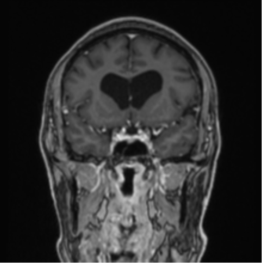 File:Colloid cyst of the third ventricle (Radiopaedia 86571-102662 Coronal T1 C+ 60).png